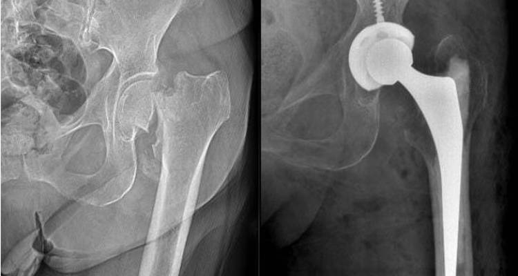Cirugia de protesis